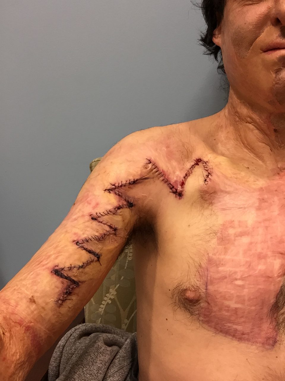 Dan Ariely surgery Z scar